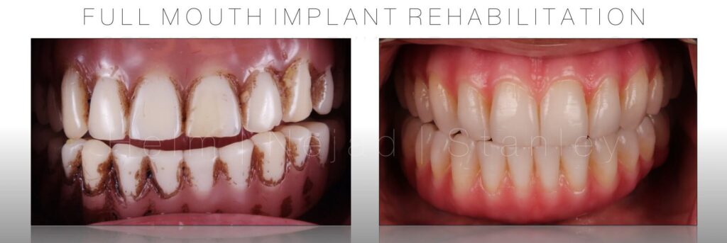 titanium better than zirconia implant