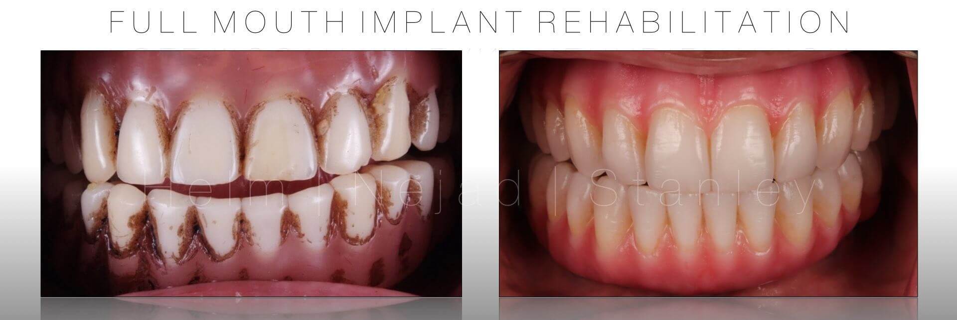 titanium better than zirconia implant