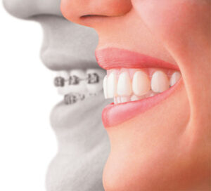 Invisalign straightens teeth while you sleep