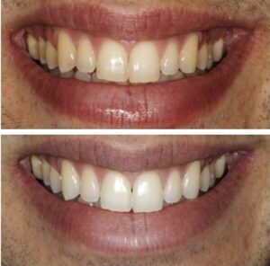 overnight teeth whitening results