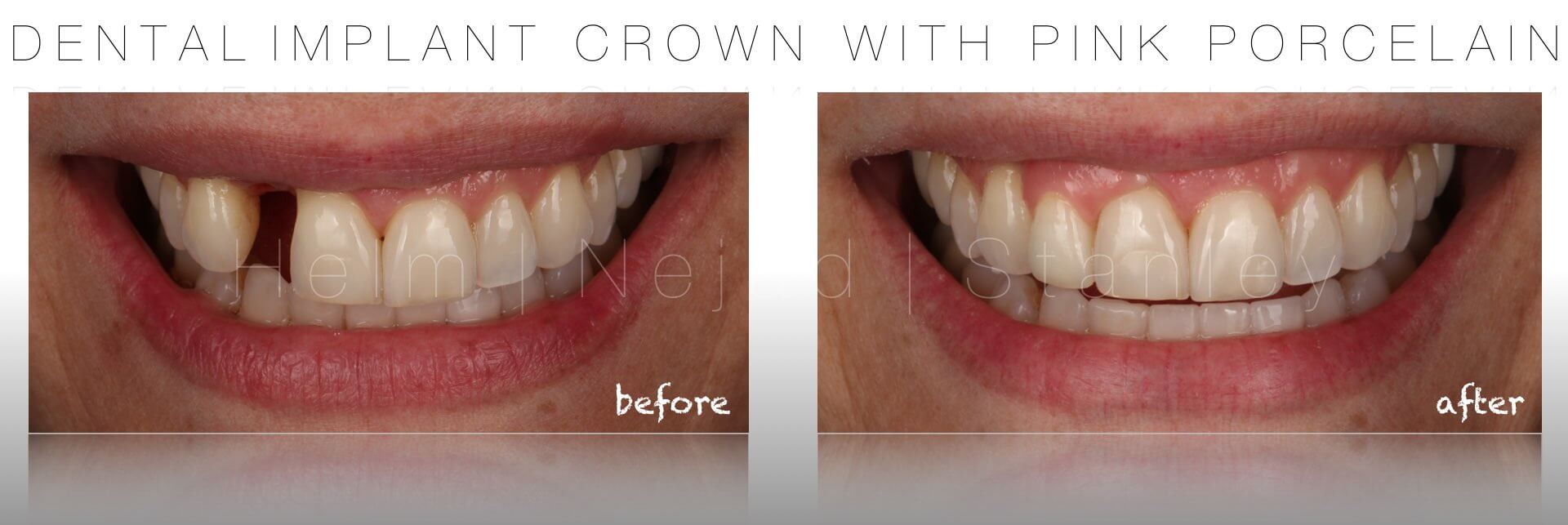 west hollywood dental implants