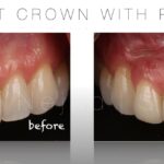 dental implant crowns