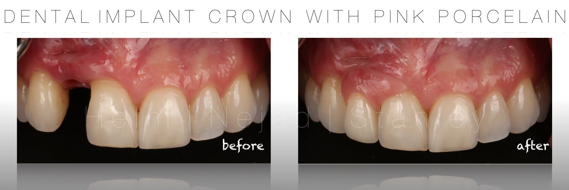 dental implant crowns