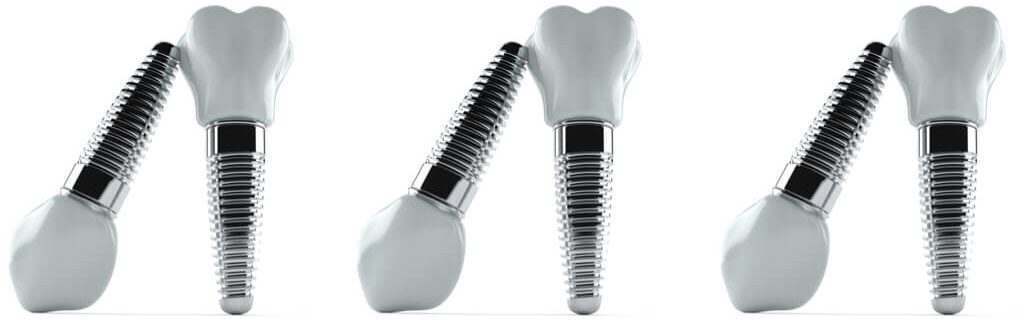 Beverly hills dental implants