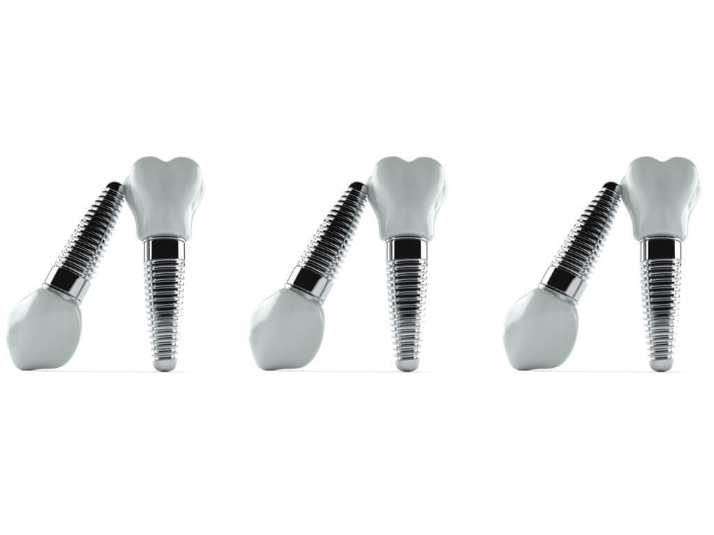 Could You be Allergic to Titanium Dental Implants? Here's what you need