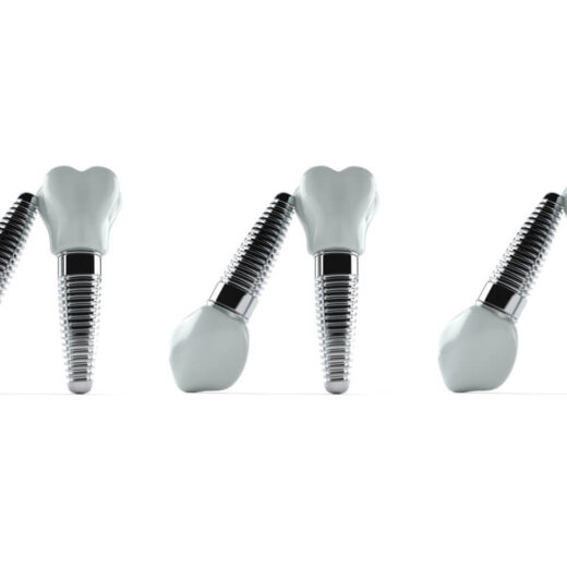 Zirconia Dental Implants Vs. Titanium Implants Which is better?