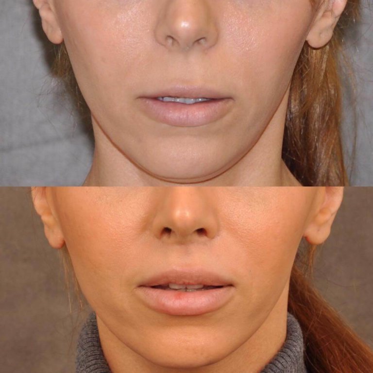 Beverly Hills Lip Lift Dentistry West Hollywood Lip Lifts Dentist