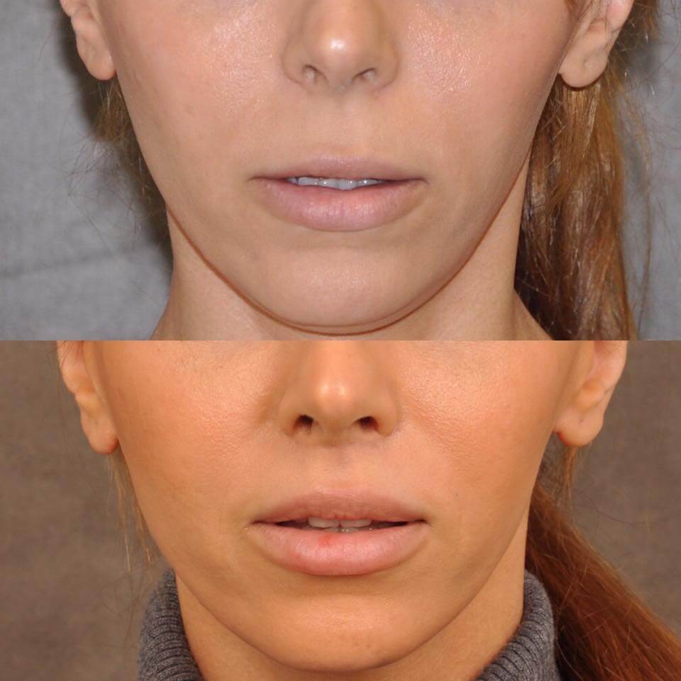 Modified Upper Lip Lift by Dr. Ben Talei