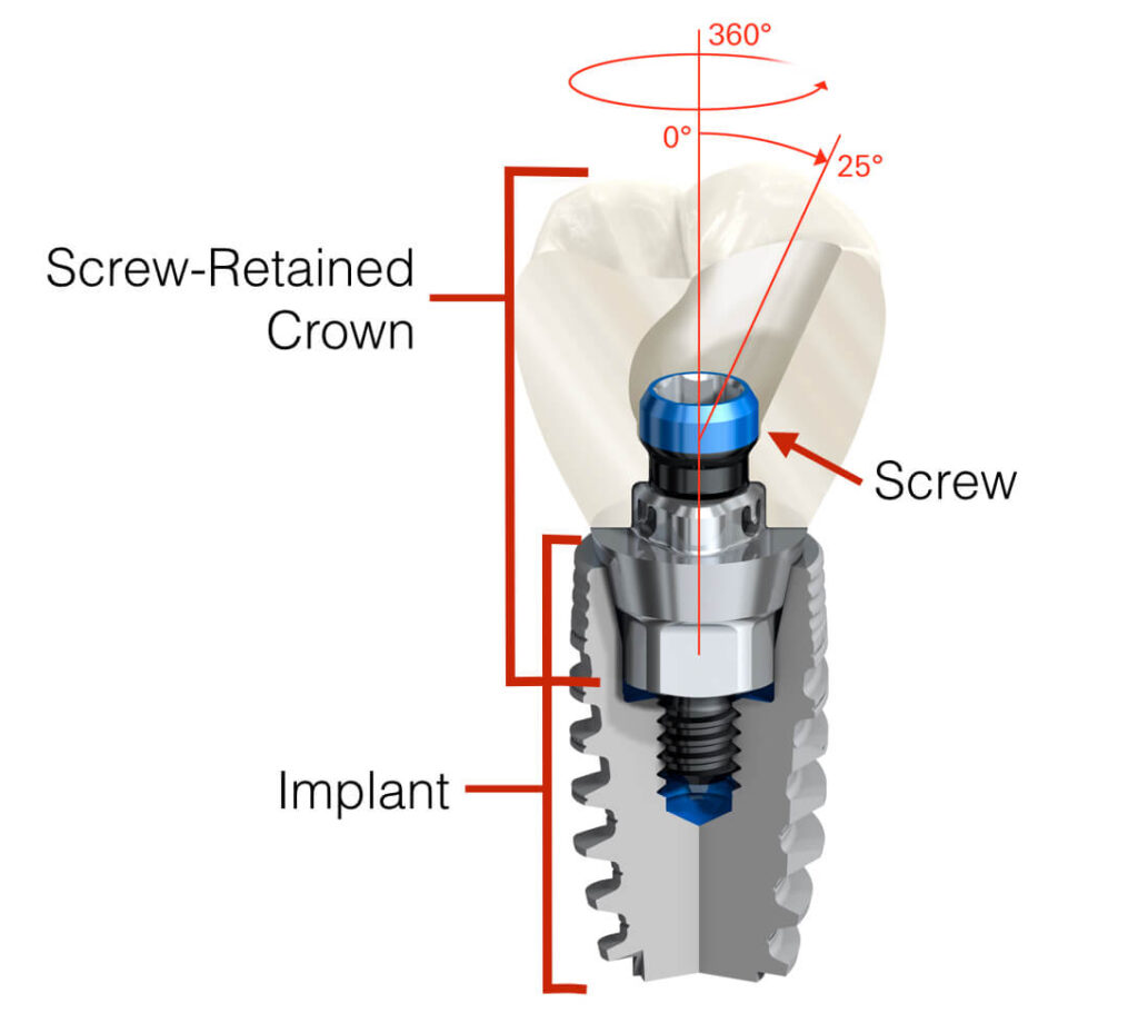 screw retained dental implant system