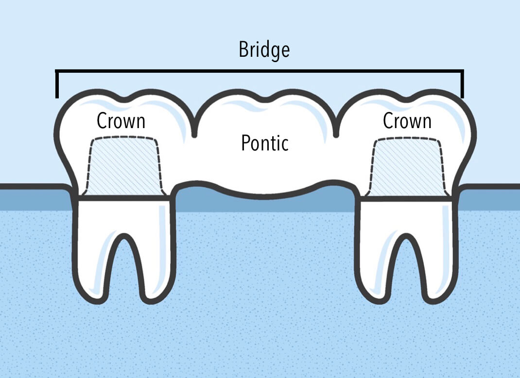 Bridge Alternative to Titanium dental implant