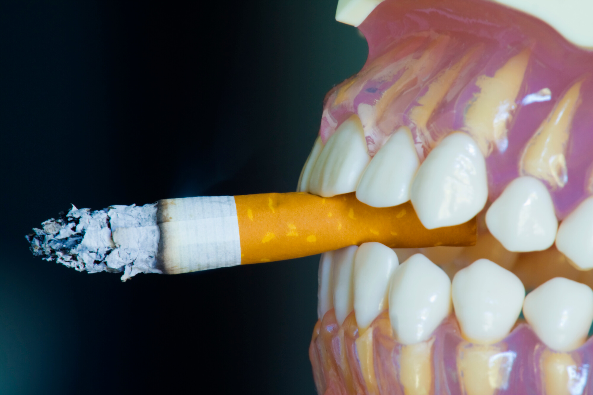 smoking causes gum recession and receeding gums