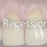 what causes gum recession graphic