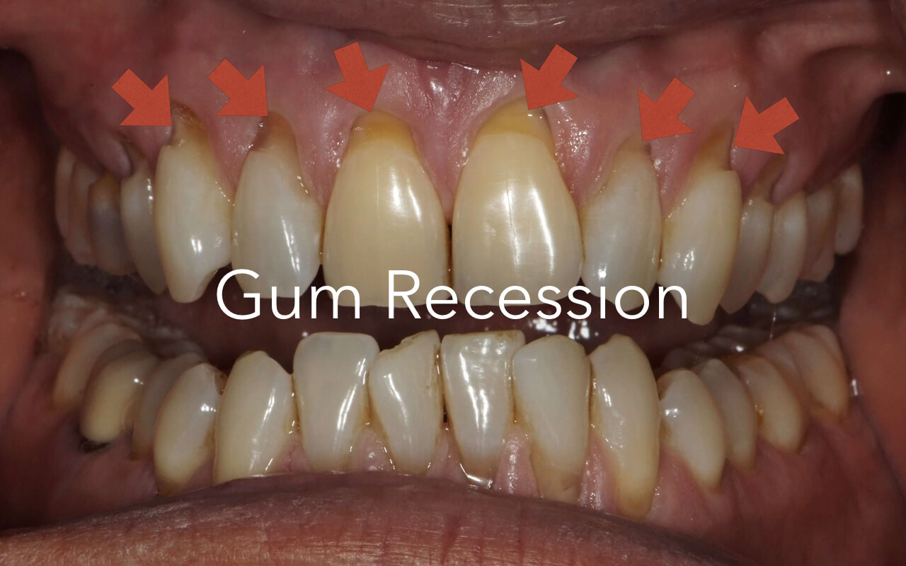 example of gum recession