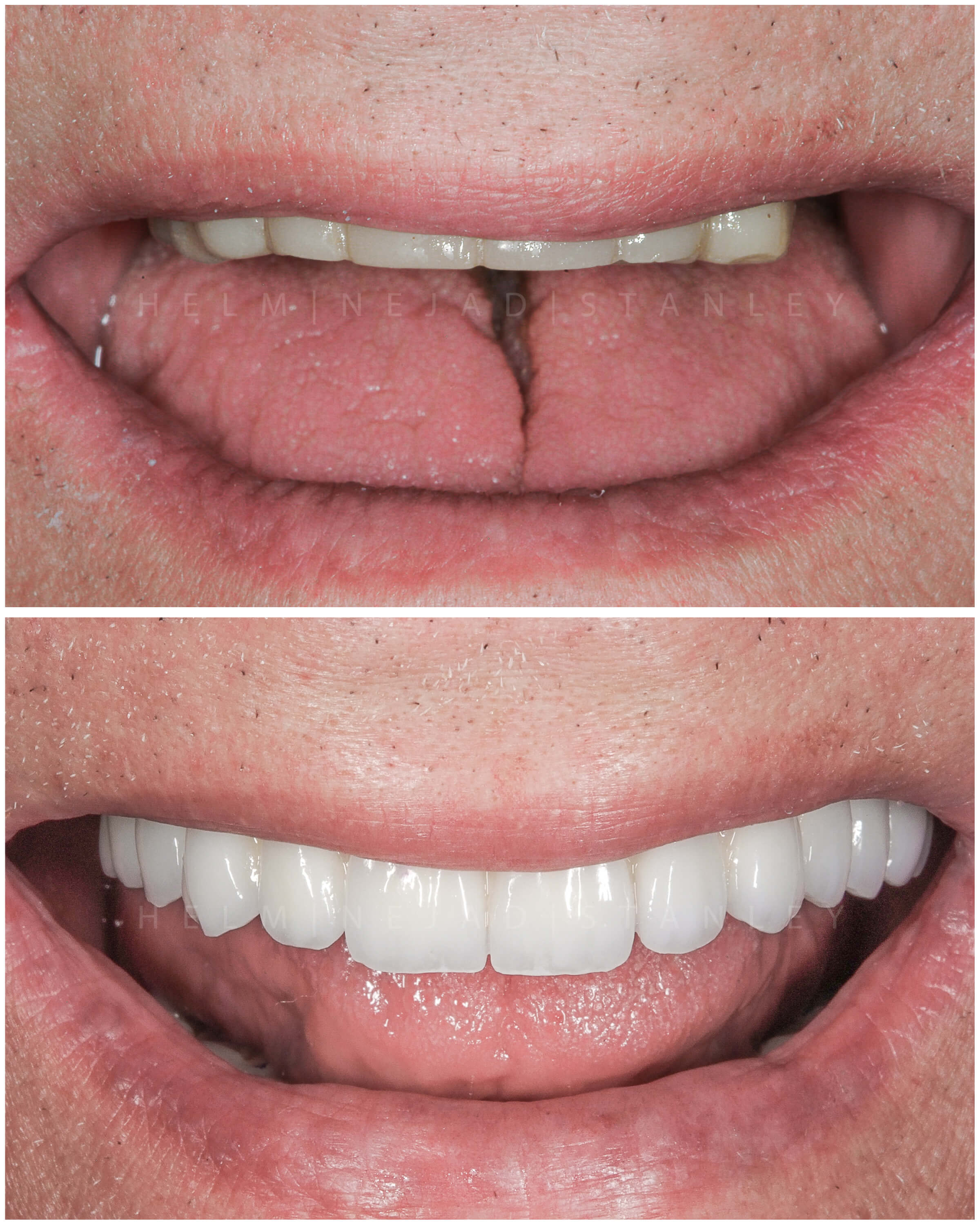 Cosmetic smile makeover before and after of the upper arch.