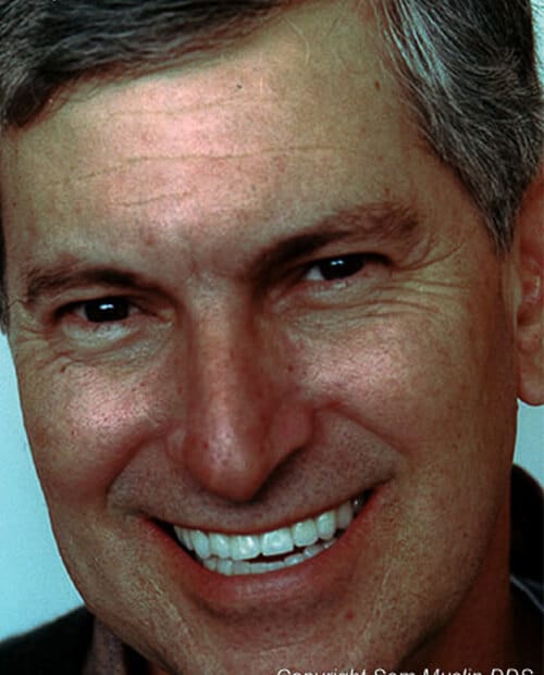 Dental Crown Alternatives