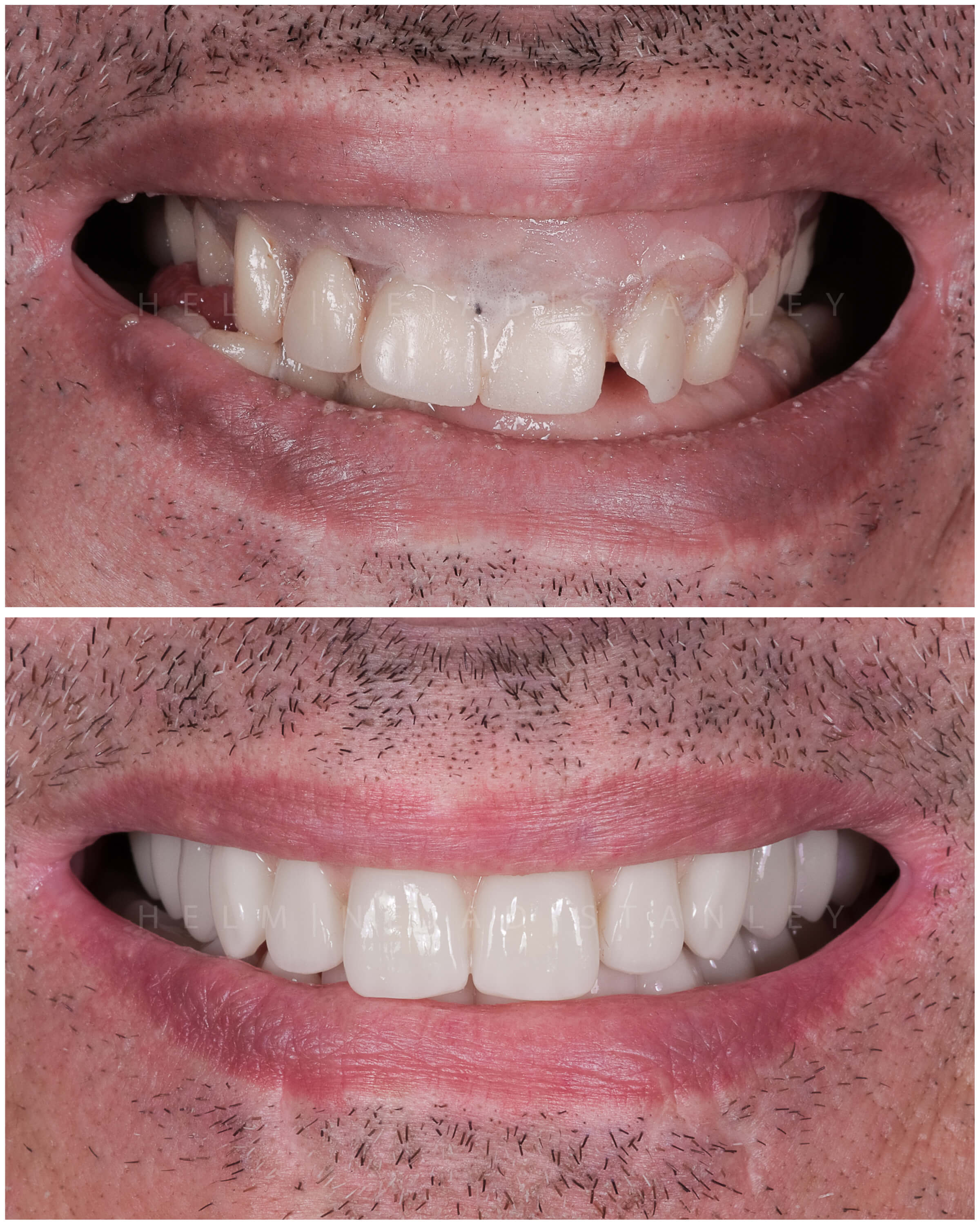 cosmetic smile makeover- before and afters with implant dentures
