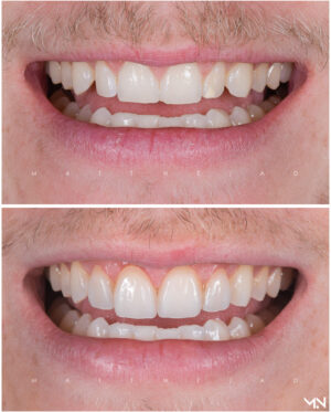 4 Porcelain Veneers- Before and after smile makeover