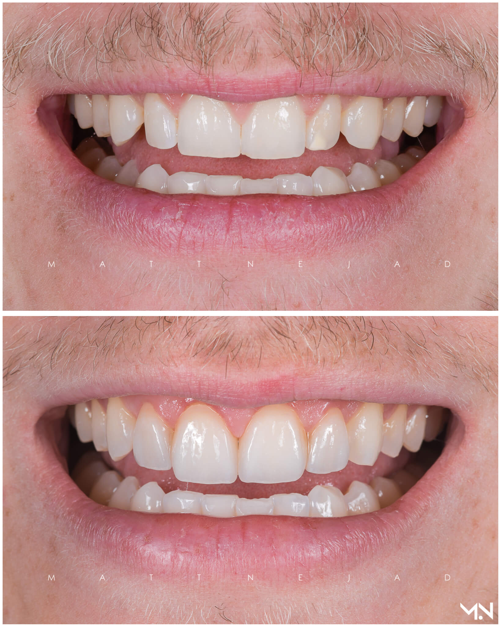 4 Porcelain Veneers- Before and after smile makeover