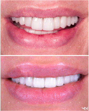 6 Porcelain Veneers to replace old veneers- Before and after smilemakeover