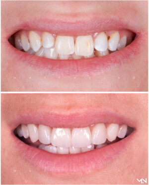 Cosmetic Smile Makeover to enhance smille - Before and after