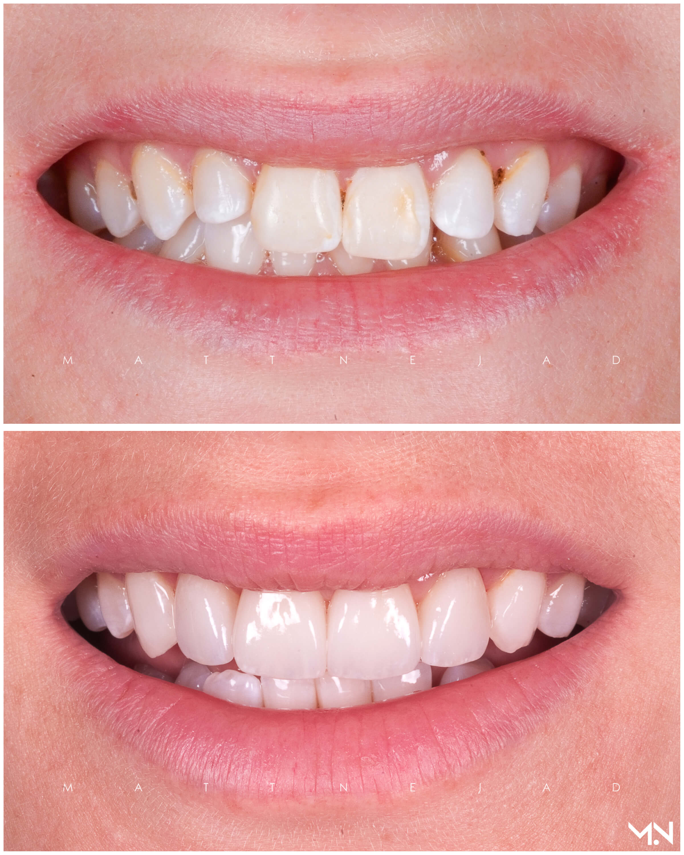 Cosmetic Smile Makeover to enhance smille - Before and after