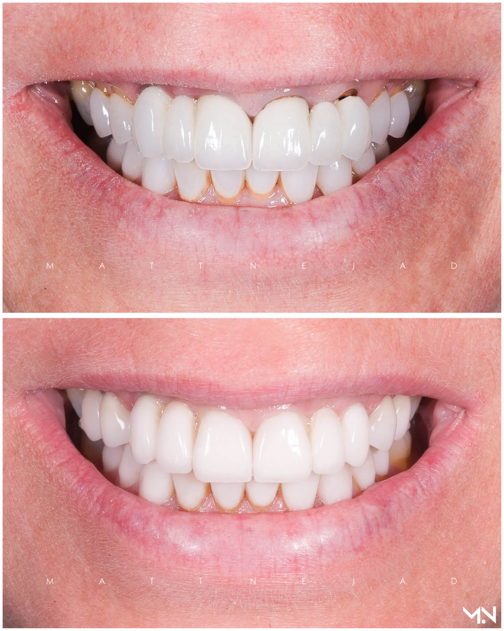 Cosmetic Smile Makeover to replace failing bridges- Before and after
