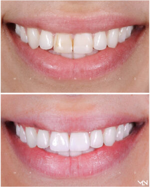 Cosmetic Smile Makeover with 2 Porcelain Veneers to replace failing bondings- Before and after