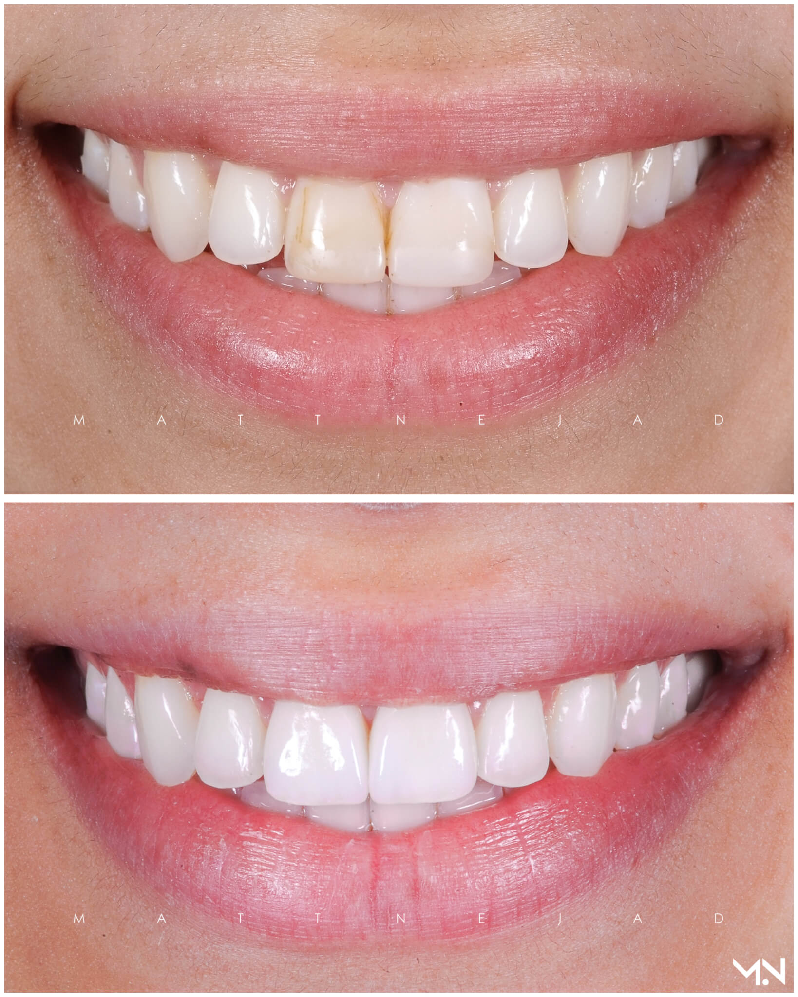 Cosmetic Smile Makeover with 2 Porcelain Veneers to replace failing bondings- Before and after