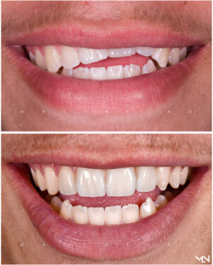 Cosmetic Smile Makeover with 4 Porcelain Veneers- Before and after