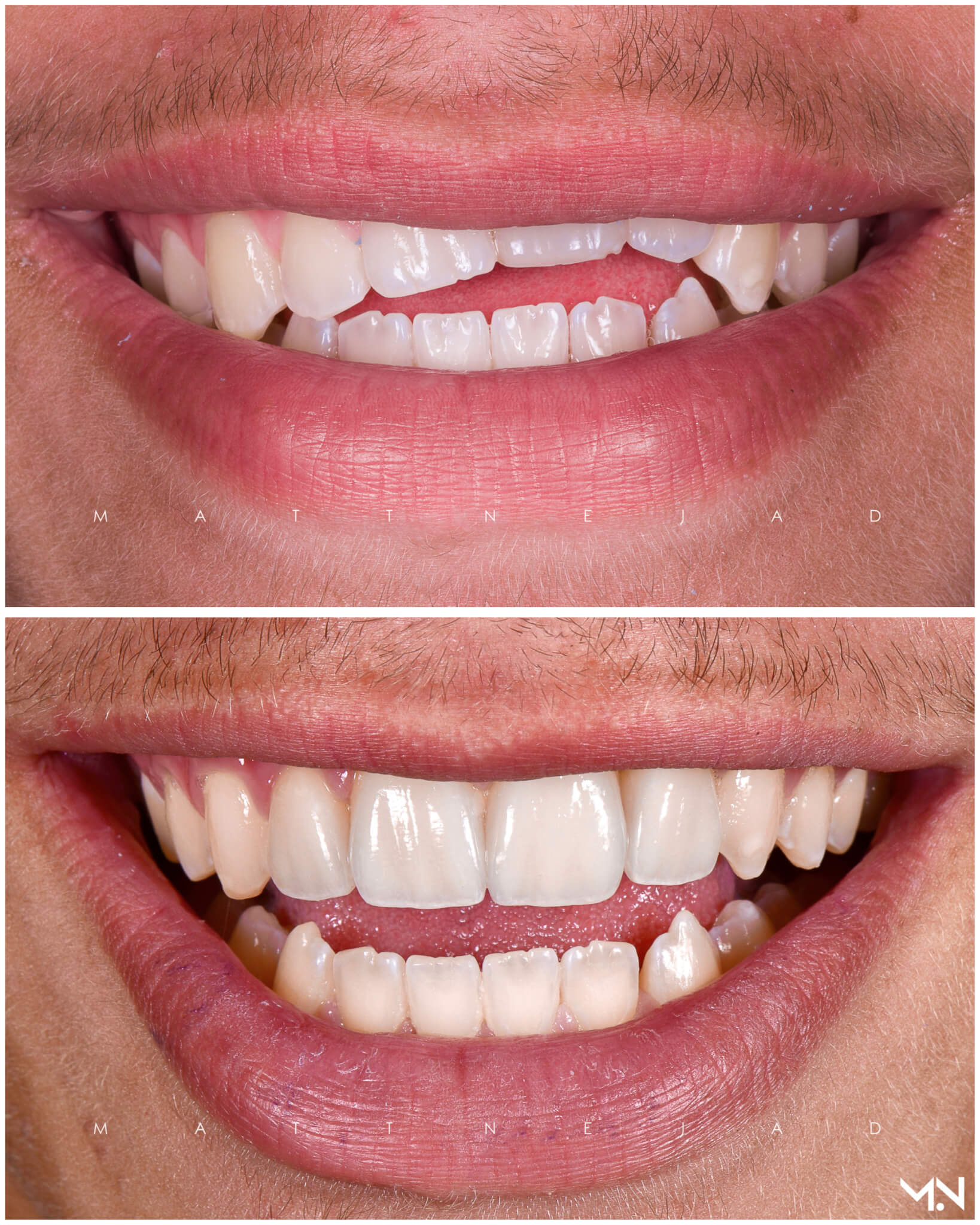 Cosmetic Smile Makeover with 4 Porcelain Veneers- Before and after