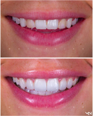 Cosmetic Smile Makeover with 6 Porcelain Veneers- Before and after