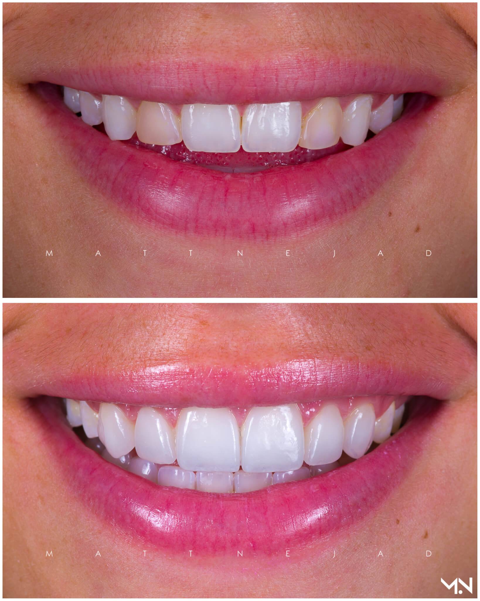 Cosmetic Smile Makeover with 6 Porcelain Veneers- Before and after