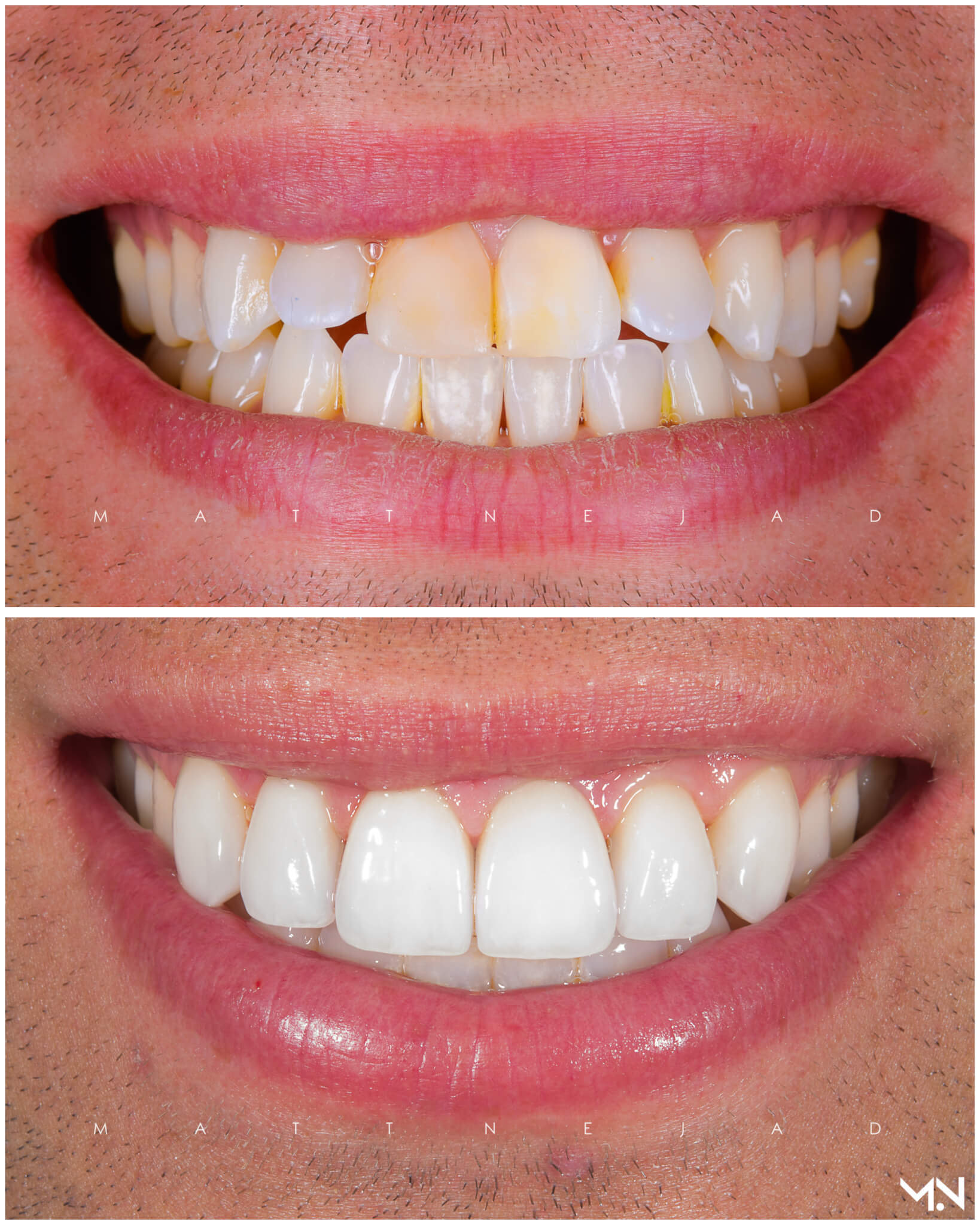 Cosmetic Smile Makeover with 6 Porcelain Veneers to correct flared teeth- Before and after