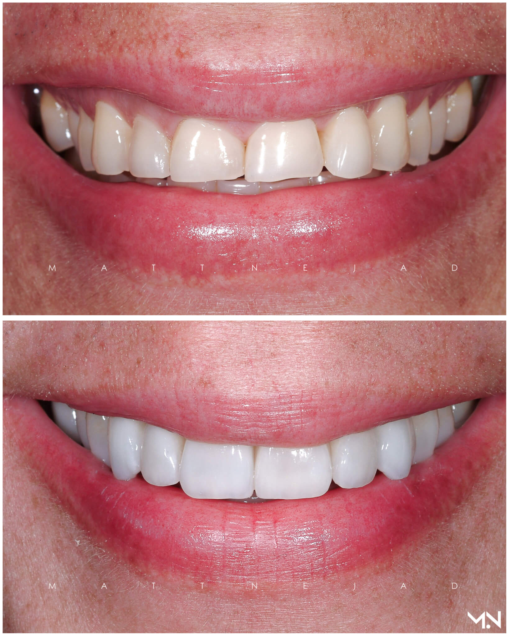 Full Mouth Reconstruction Smile Makeover - Before and After