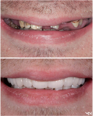 Full Mouth Reconstruction and Smile Makeover - Before and After