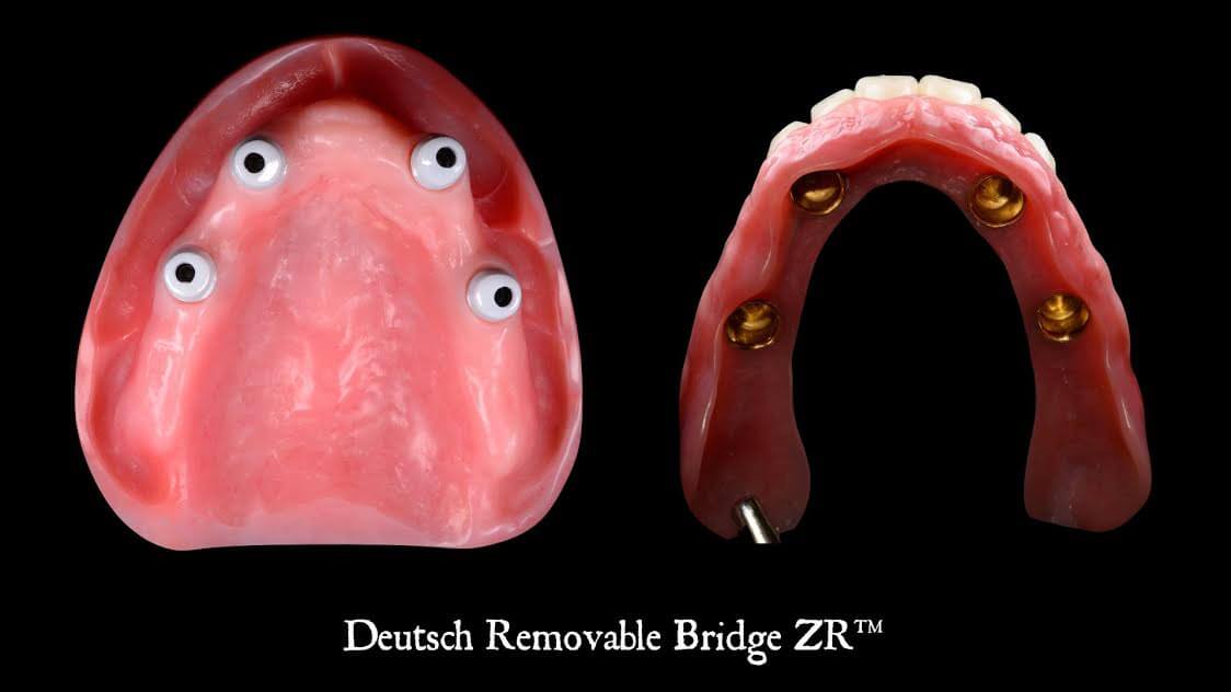 deutsch removable bridge dental implant