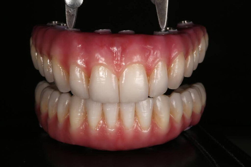 Permanent Denture Options Pros & Cons