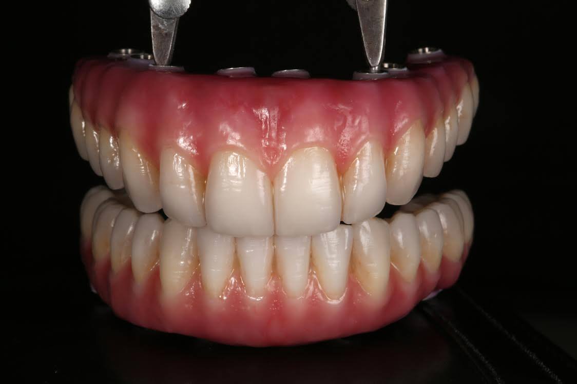 Full Contour Zirconia bridges with Custom porcelain work