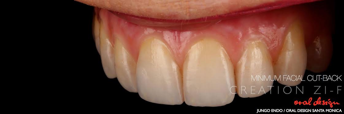 full contour zirconia with minimal facial cutback