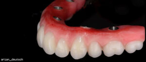 hybrid denture with implants
