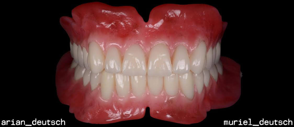 snap in snap on denture overdenture