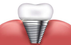 Beverly Hills CA Dental Implant Specialists