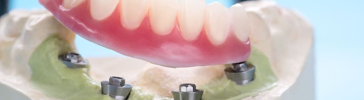 implant fixed bridge or denture