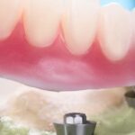 implant fixed bridge or denture