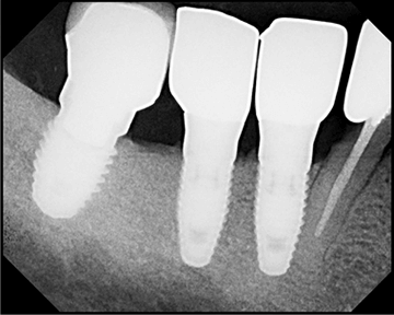 Poorly placed dental implant