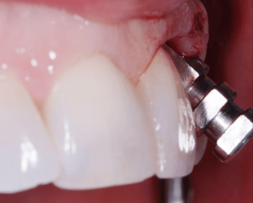 Poorly placed dental implant