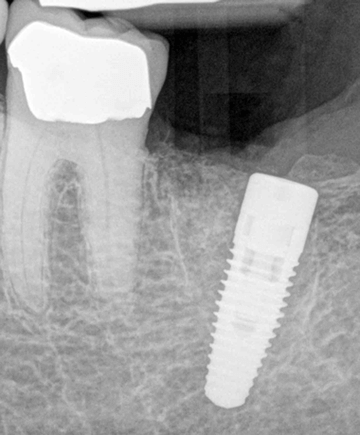 Poorly placed dental implant