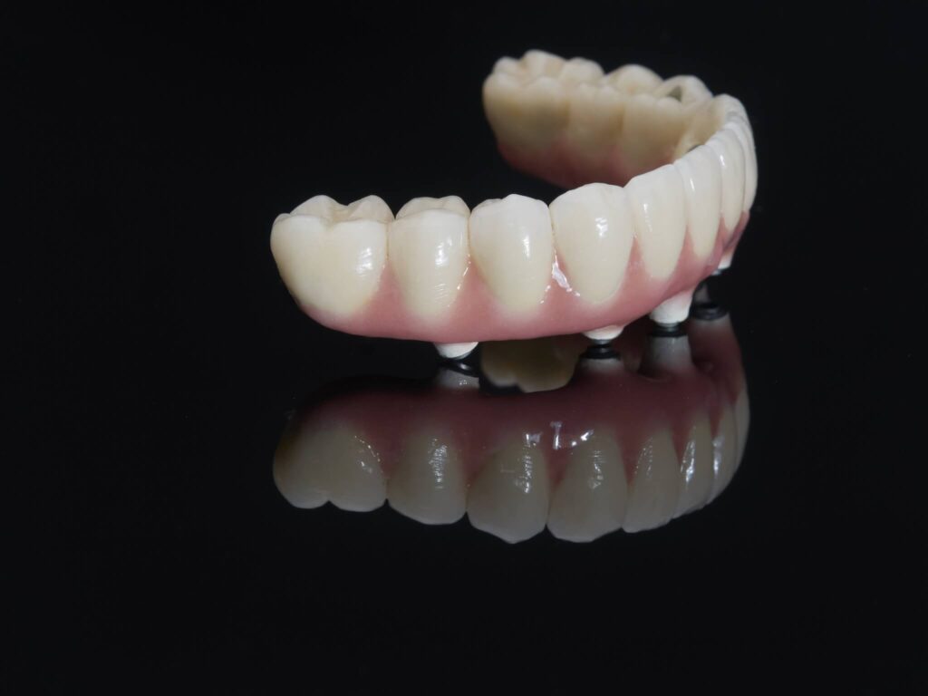 Complete lower and upper metal ceramic prosthesis dental screwed directly to implant.