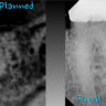 Planning the placement of the implant