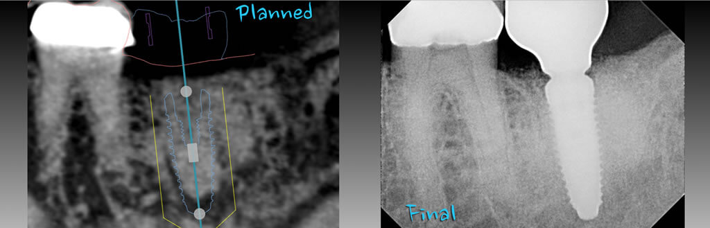 Planning the placement of the implant